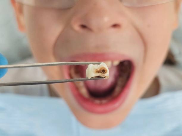 Best Emergency Root Canal Treatment in Crooked Lake Park, FL